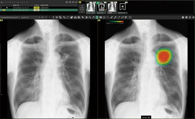 CXR-AID